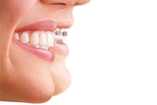 invisible braces