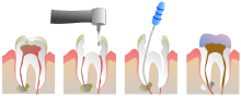 root canal treatment