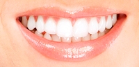 safe teeth whitening