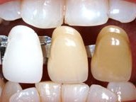 teeth whitening